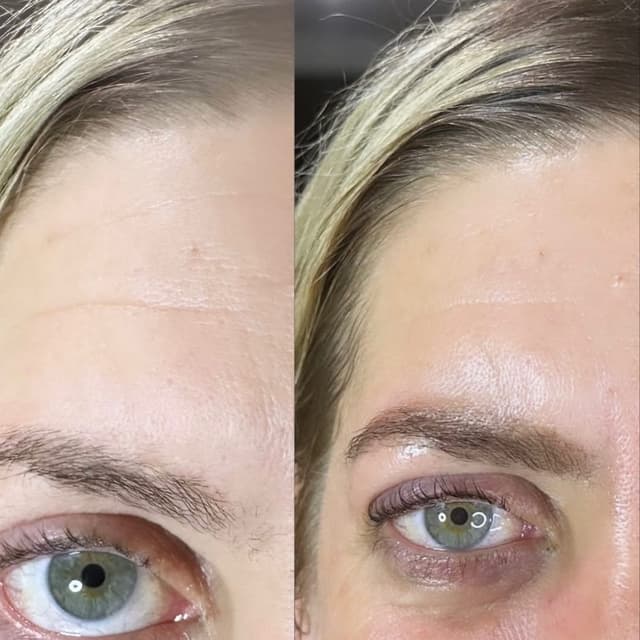 CHEMICAL PEEL SERIES at A Glow By Laura in Philadelphia, PA
